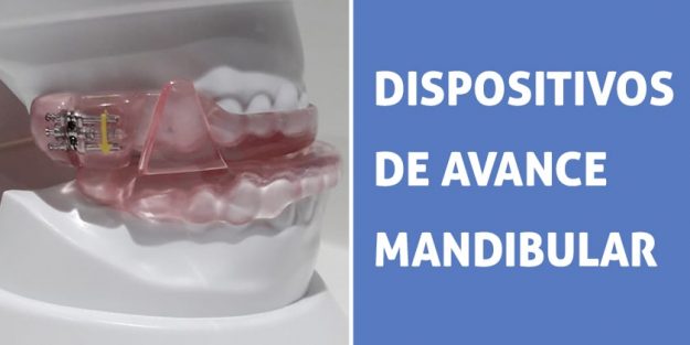 Dispositivo de avance mandibular para el tratamiento de pacientes RONCADORES o con SÍNDROME DE APNEA OBSTRUCTIVA DEL SUEÑO